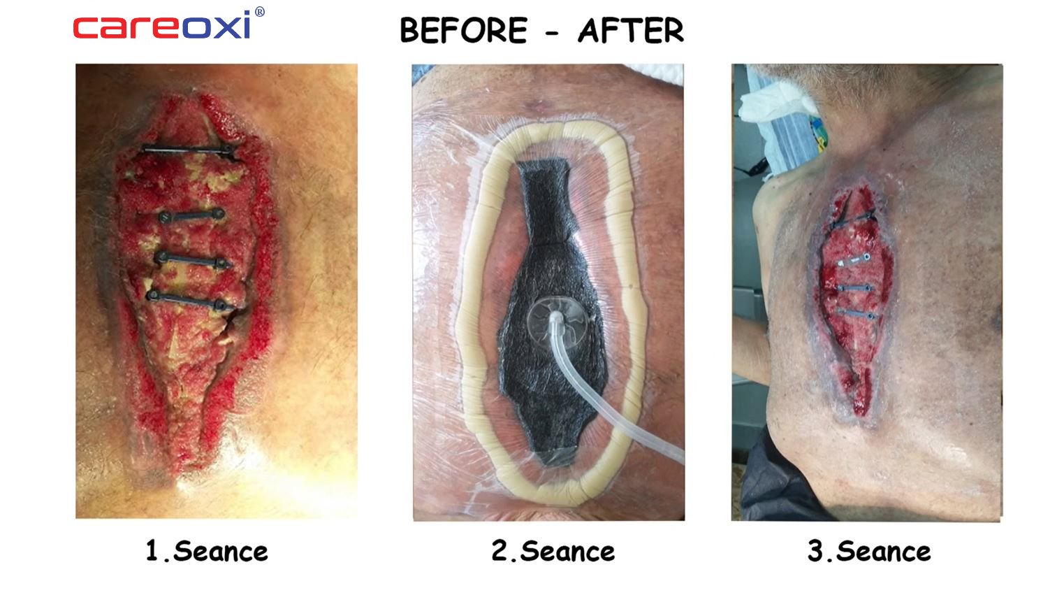 NPWT Wound Treatment Incision Wound Case Results