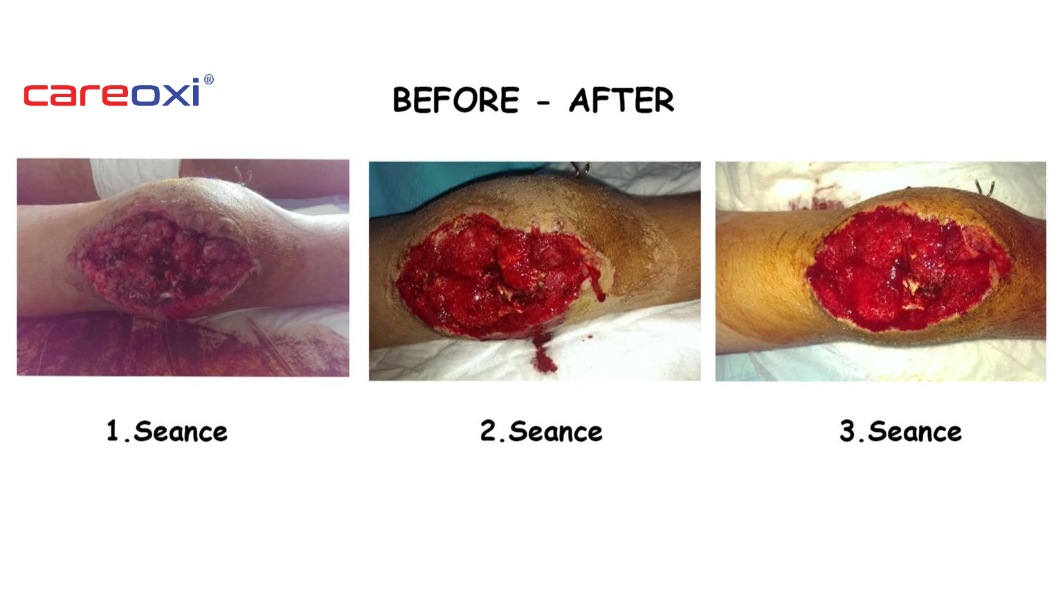 NPWT Wound Treatment Wound Case Results